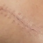 Cicatrici gonfie: come riconoscere e quali sono i rimedi efficaci per trattare le cicatrici ipertrofiche